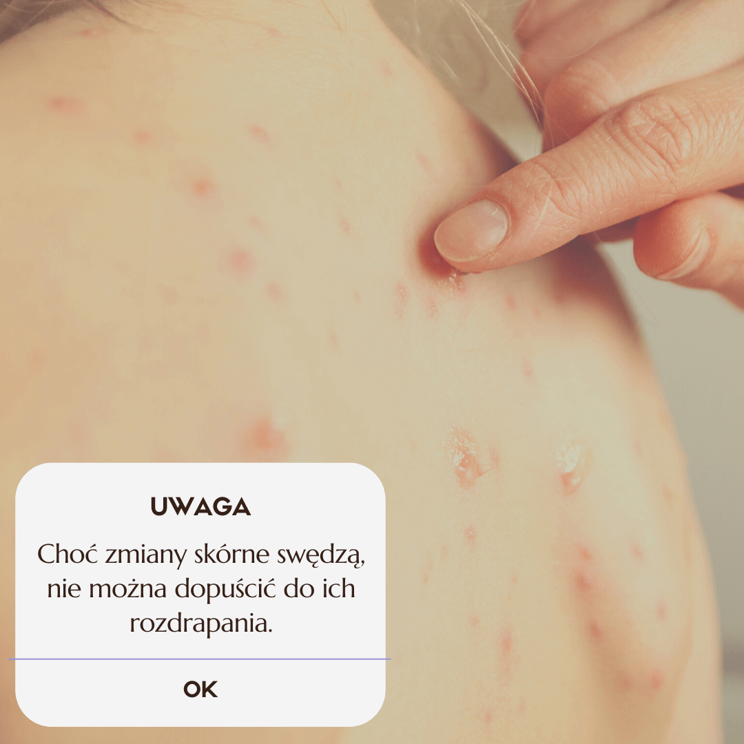 Ospa dzień po dniu. Jak wygląda przebieg choroby?