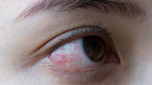 Jaskra – niebezpieczna i podstępna choroba oczu!