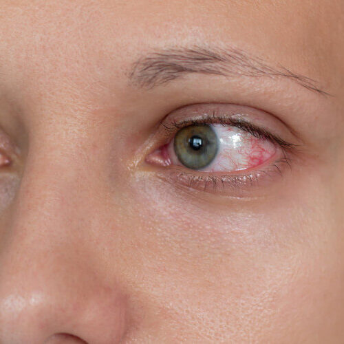 Alergiczne zapalenie spojówek – co robić, gdy oczy swędzą, pieką i puchną?