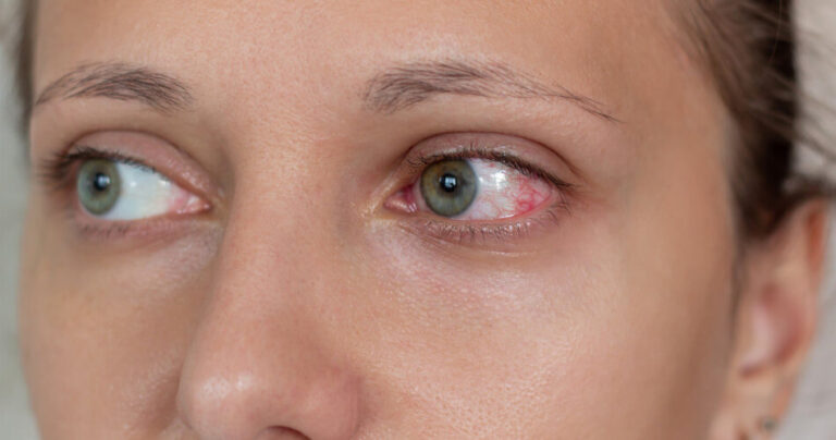 Alergiczne Zapalenie Spojówek Objawy I Leczenie • Ratownik Medyczny 0803