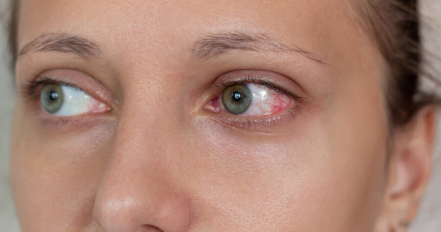 Alergiczne zapalenie spojówek – co robić, gdy oczy swędzą, pieką i puchną?