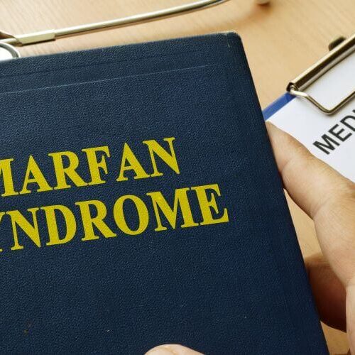 Syndrom Marfana – codzienność z chorobą. Jak objawia się zespół Marfana i czy można go leczyć?